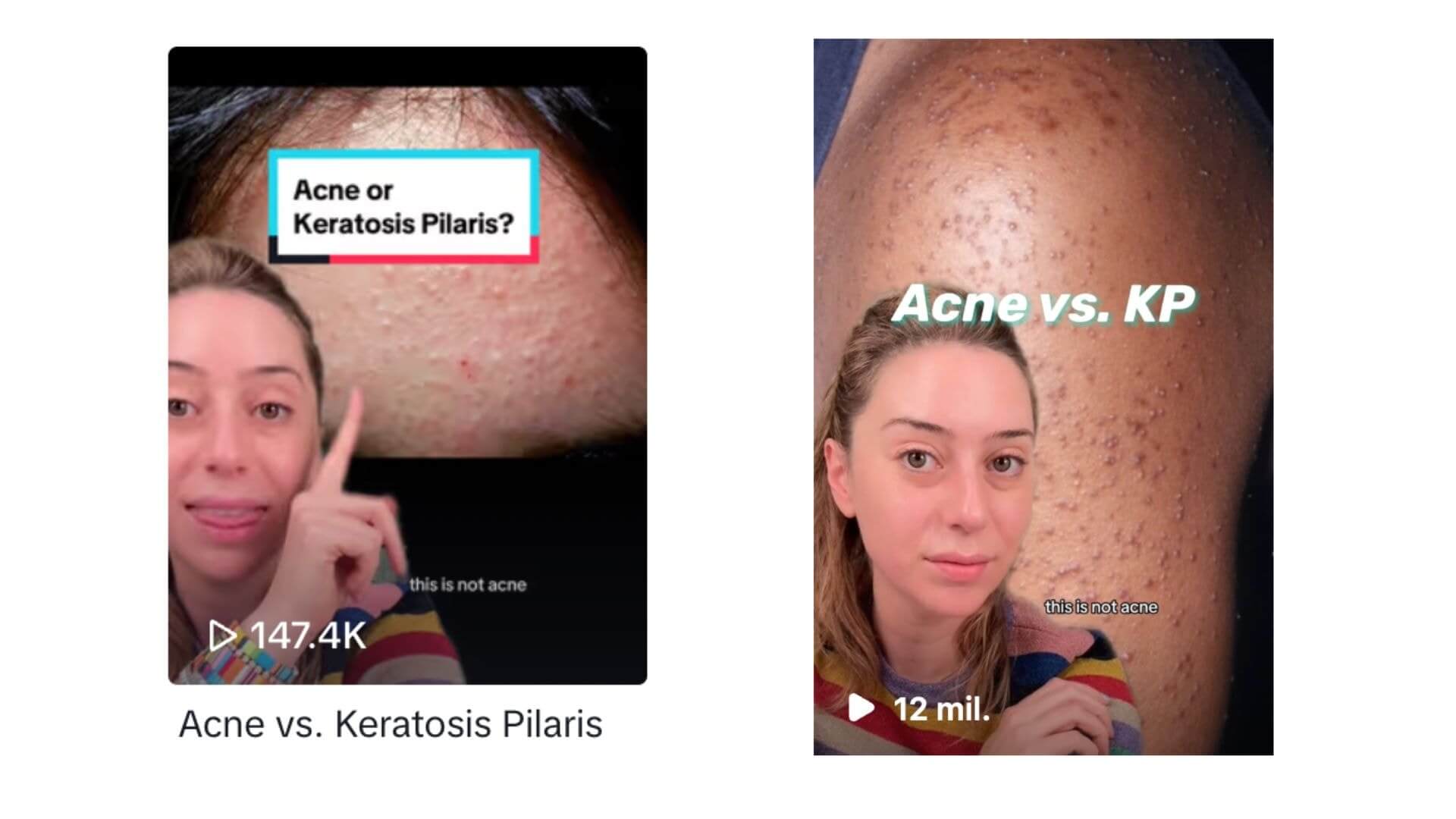 Two screenshots from tiktok vs ig reel comparing acne and keratosis pilaris, each featuring a woman pointing to close-up skin images with labels.